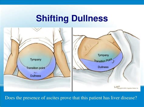 shifting dullness abdomen